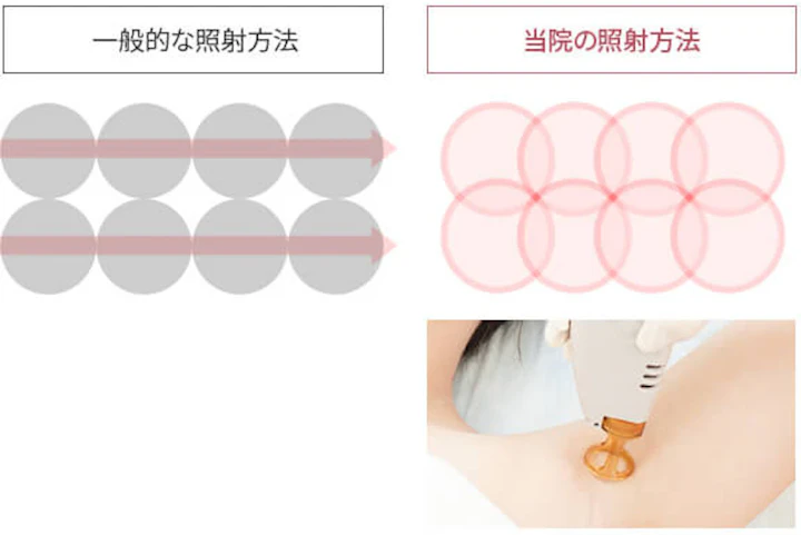 照射範囲を1/3ずつ重ねて打ち漏れを防止