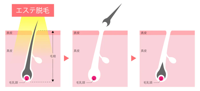 エステ光脱毛の仕組み