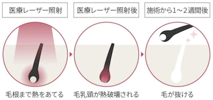 医療レーザーは成長期にあたるムダ毛を処理する