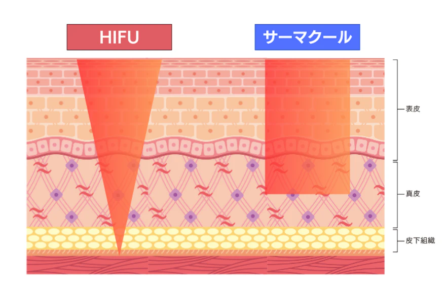 HIFU（ハイフ）とサーマクールの違い