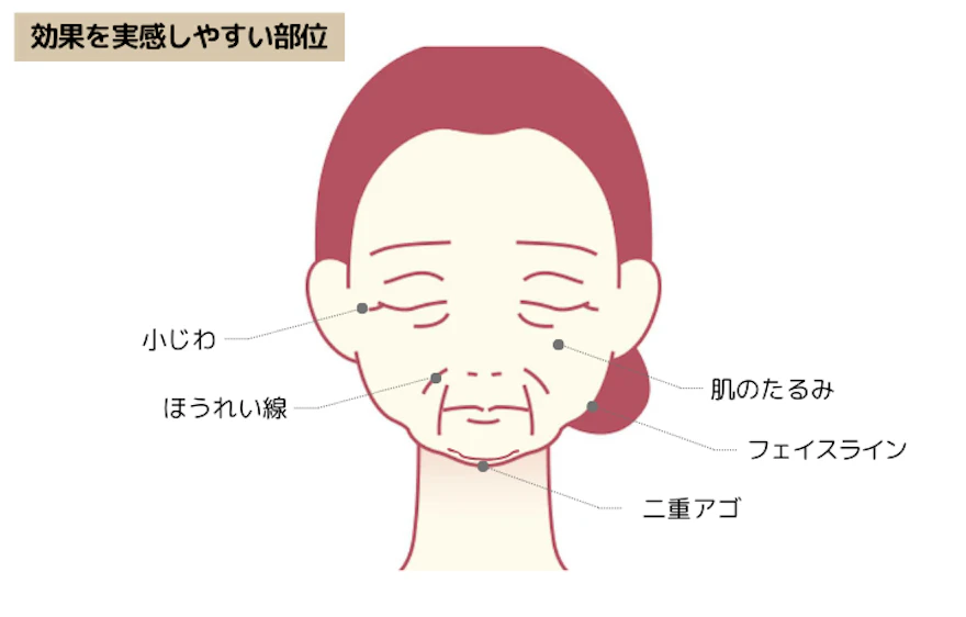 HIFU（ハイフ）の効果