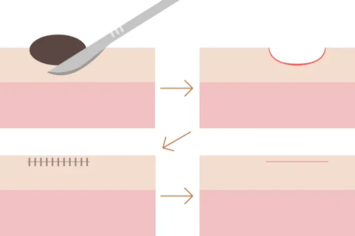 再発リスクを抑えた「切縫法」