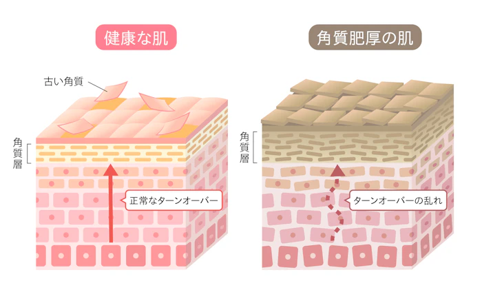 ①肌のターンオーバーを正常に保つ