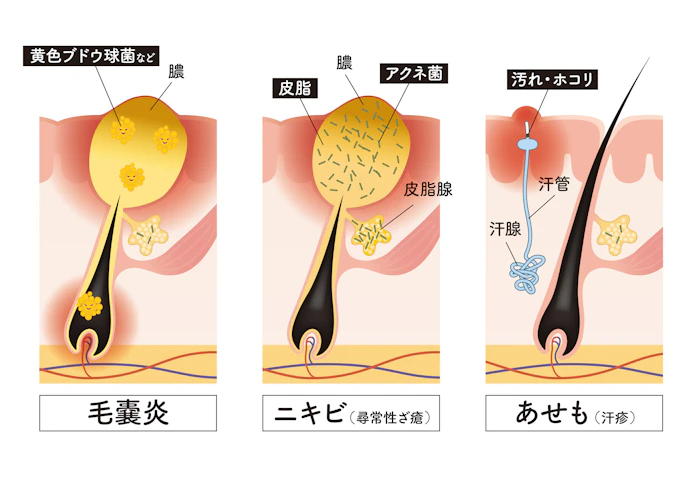 毛嚢炎とニキビの違いは？