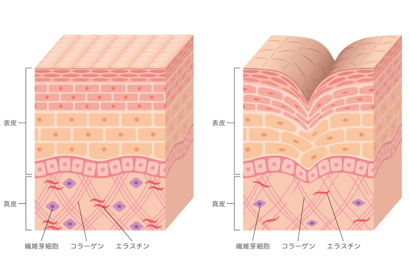 針の先端から高周波エネルギー（RF）の照射