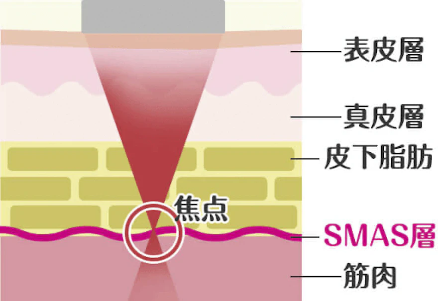 HIFU（ハイフ）とは？