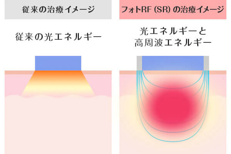 フォトRF（SR）の仕組み