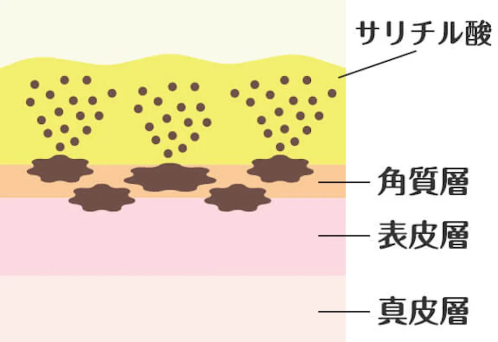 サリチル酸ピーリングとは？