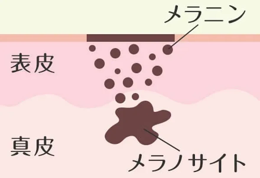 レーザートーニングで色ムラ改善