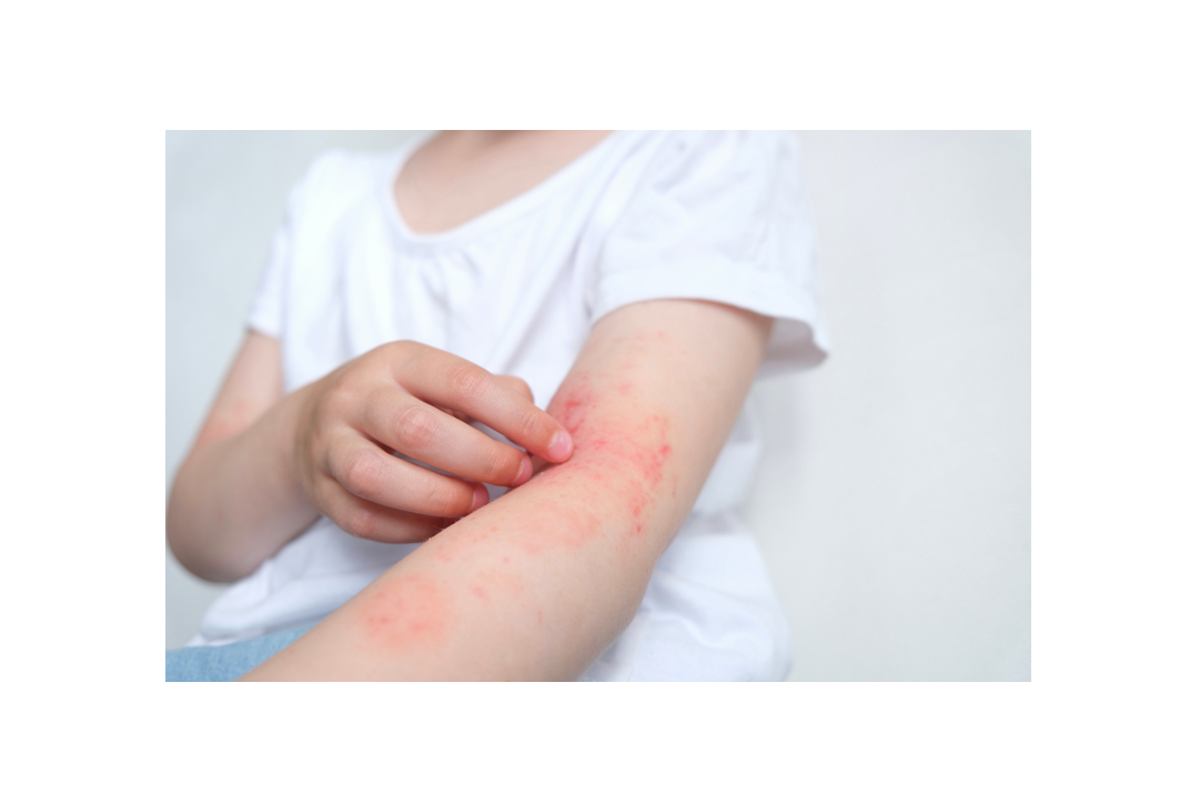 アトピー性皮膚炎