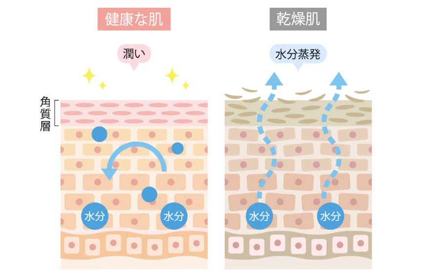 乾燥が原因のニキビにも有効