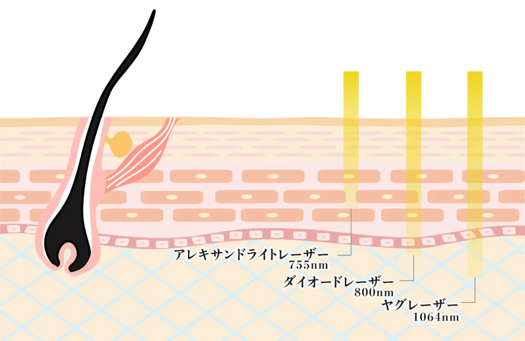 ヤグレーザーとは？医療脱毛の仕組み