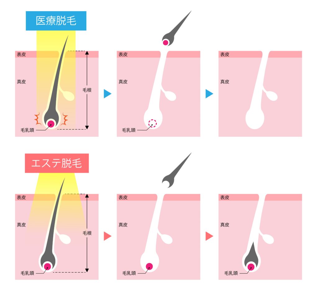 医療脱毛とサロン脱毛の違い