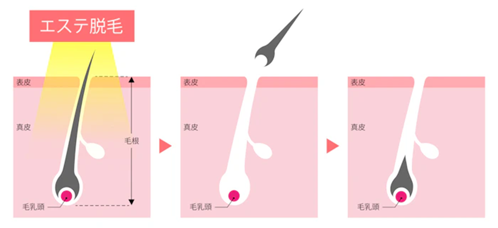 家庭用脱毛器やエステ脱毛との違い