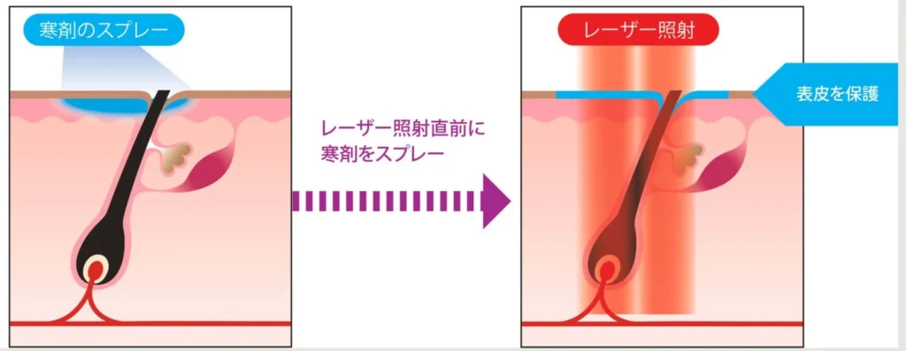 強力な冷却機能で痛みを軽減できる