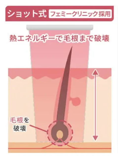 ショット式(熱破壊式)の医療レーザー脱毛