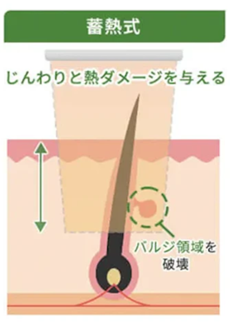 蓄熱式の医療レーザー脱毛