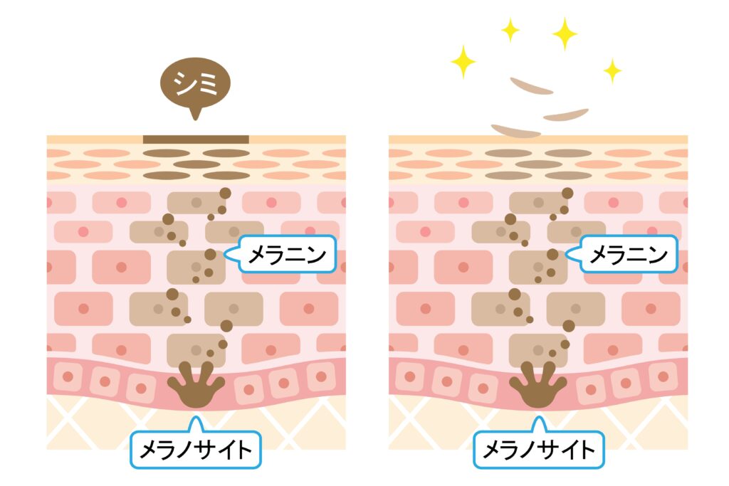 フォトフェイシャルなど「フォト治療」の仕組み