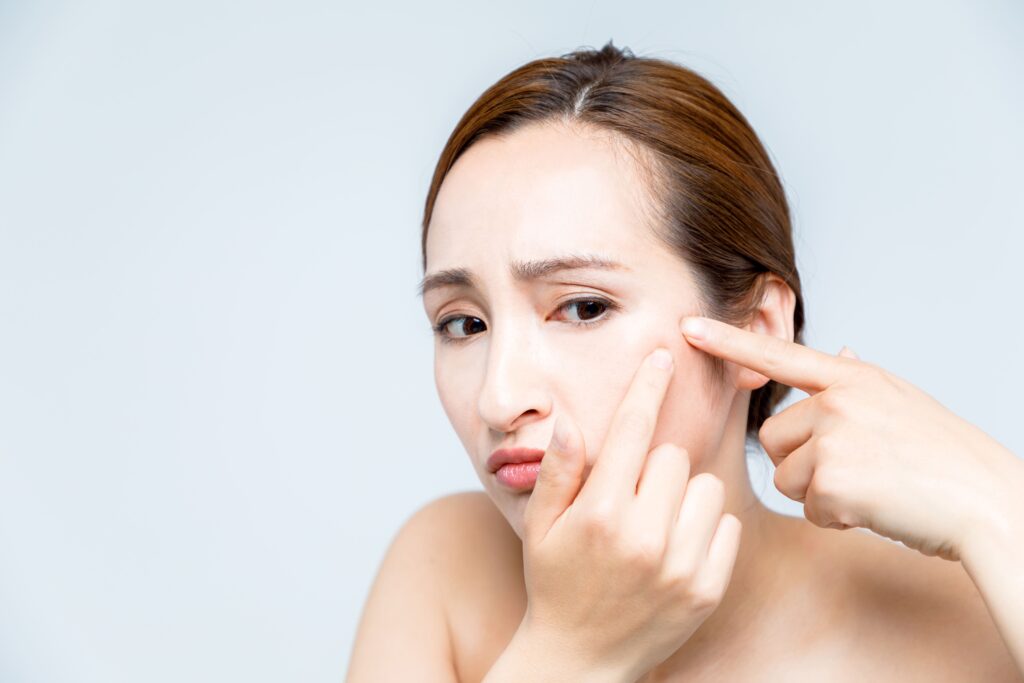 ニキビをいじらない・潰さない