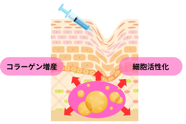 リモデリング