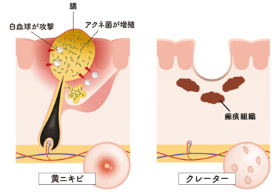 肌が凹んでしまうメカニズム