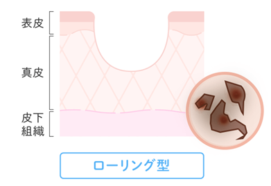 ローリング型(広く浅めの凹み)
