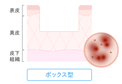ローリング型(広く浅めの凹み)