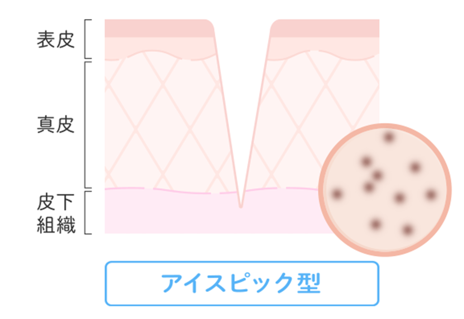 アイスピック型(細く深い凹み)