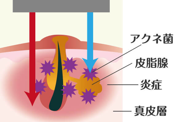 クリアタッチSによるニキビ治療の仕組み