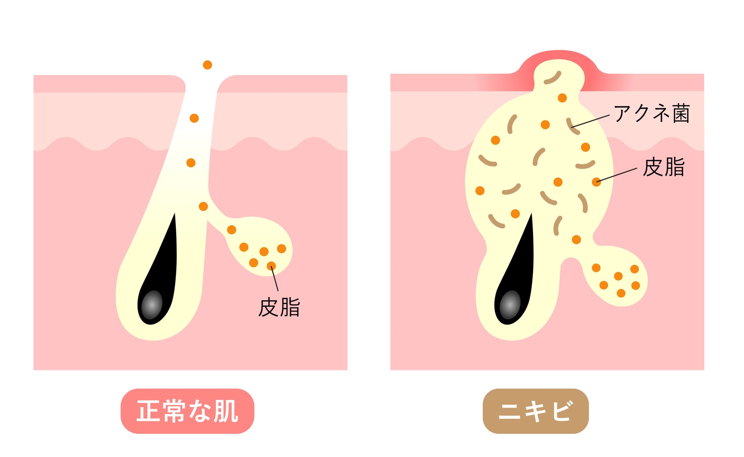 リバースピール