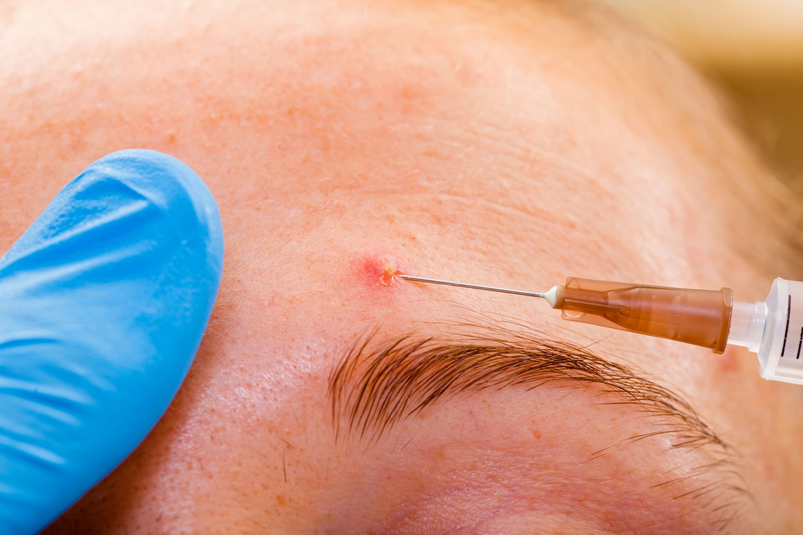 リバースピール