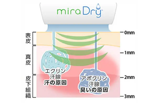 ミラドライで汗腺を破壊する