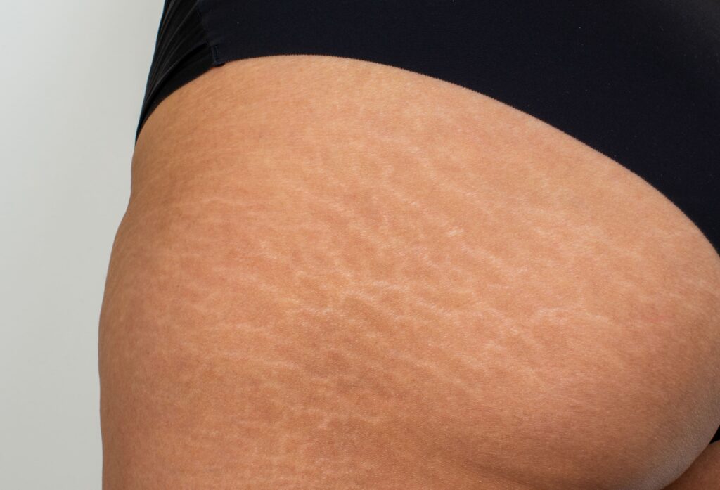  おしりの肉割れとは？ 皮膚が断裂して起こる仕組み