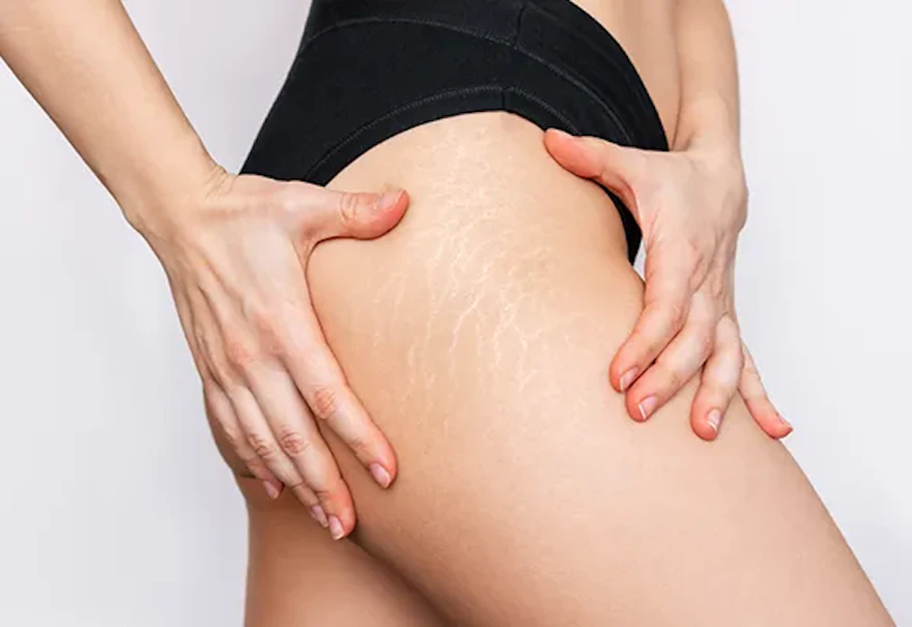 おしりの肉割れの原因と治し方｜自宅でできるセルフケアから治療法まで