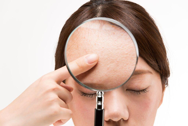 ステロイドがニキビに与える影響と自己判断での使用はおすすめしない理由