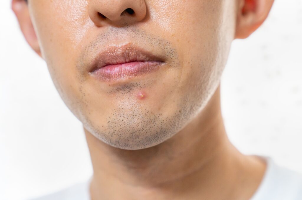 なぜ男性の肌はニキビができやすいのか?