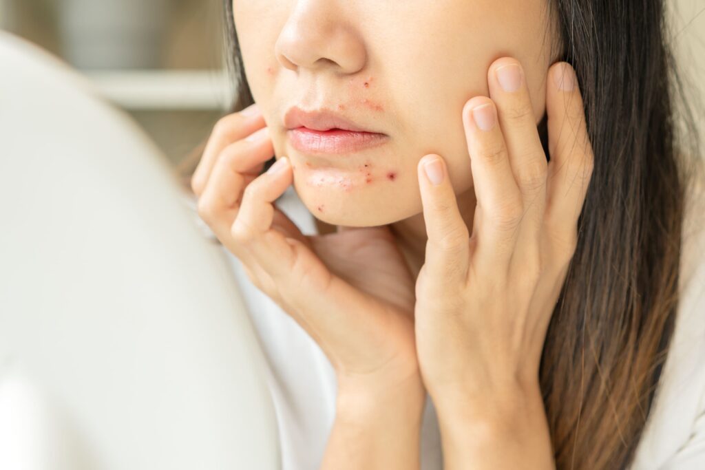 ニキビがかさぶたになる2つの主な原因