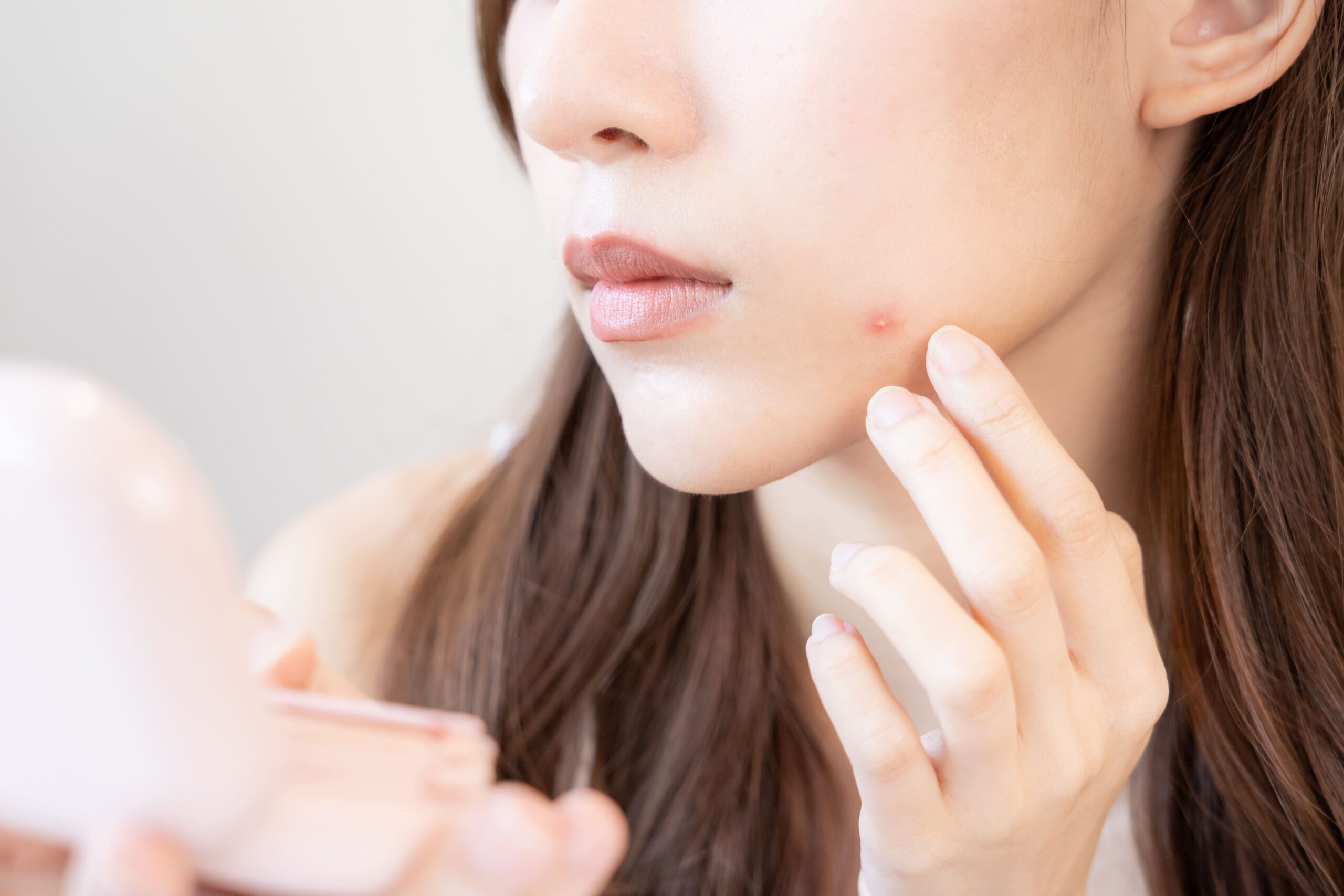 ニキビの炎症はなぜ起きる？原因と膿への対処法、効果的な薬を解説